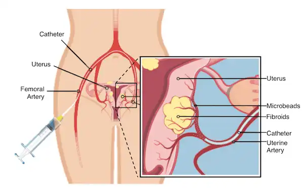 Uterine fibroid embolization