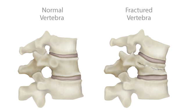 fractured vertebra