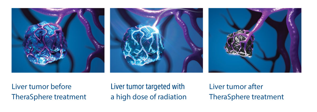 RADIATION TARGETS THE TUMOR WITH MINIMAL IMPACT TO THE SURROUNDING