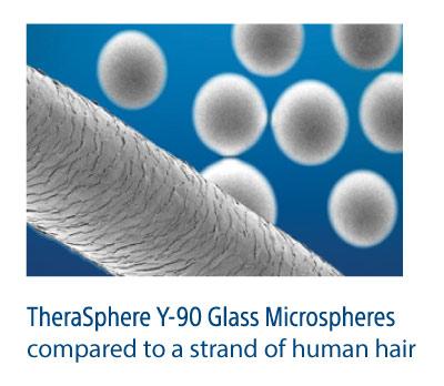 TheraSphere is a treatment consisting of millions of tiny glass beads